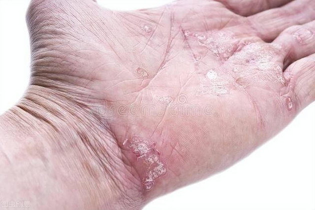 身上痒痒痒？这个“不死的癌症”你一定要知道