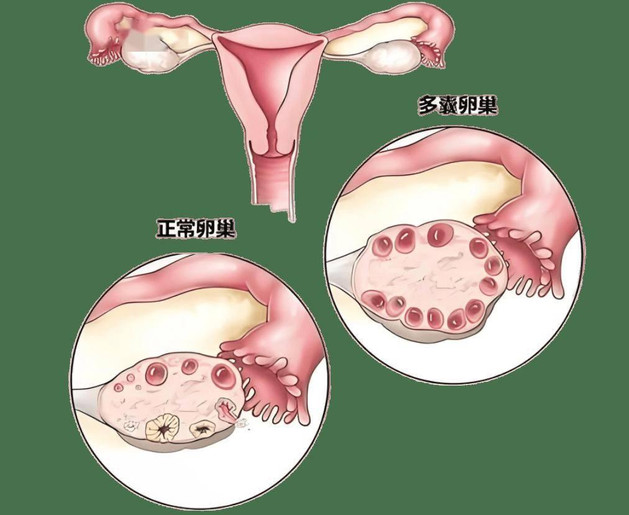 多卵泡≠易怀孕，破解多囊卵巢综合征生育之谜