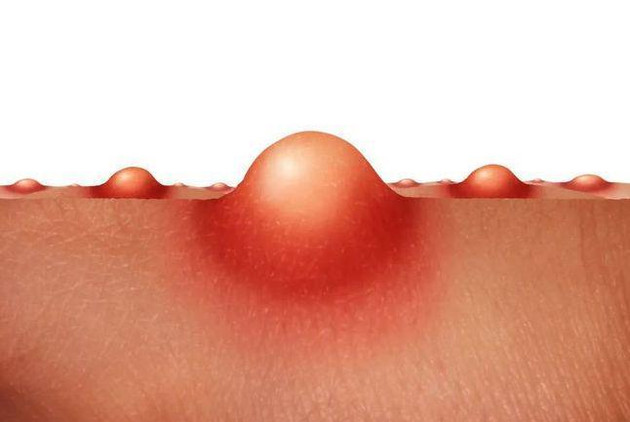 反复发作有苦难言的隐私处疱疹，你想知道的都在这里