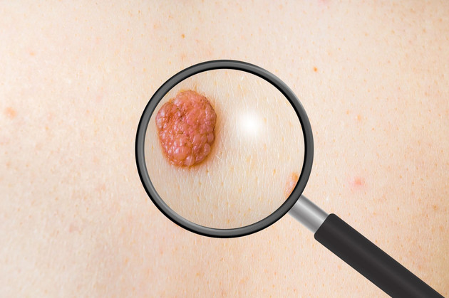 体内有恶性肿瘤的人，身体一般会有这些表现